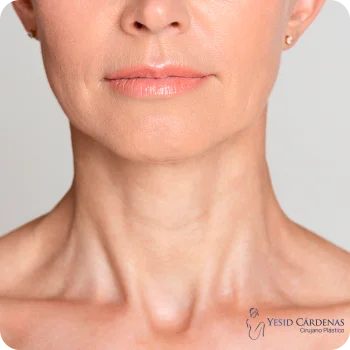 Medellín Colombia Radiesse