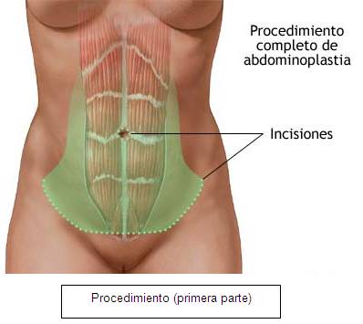 Abdominoplastia Medellin