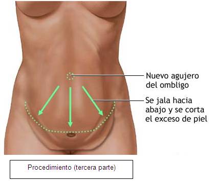 Abdominoplastia Medellin