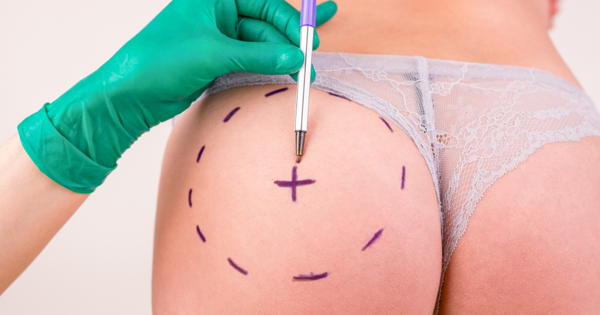 Levantamiento de glúteos en Medellín