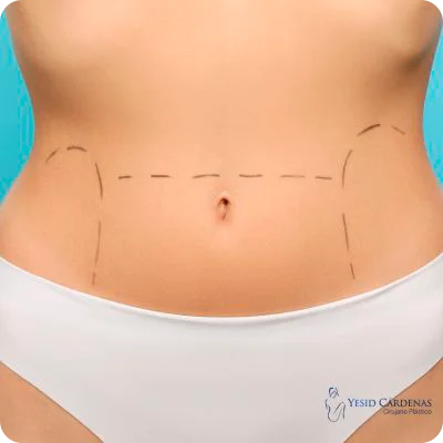 Abdominoplastia Medellín Yesid Cárdenas Colombia