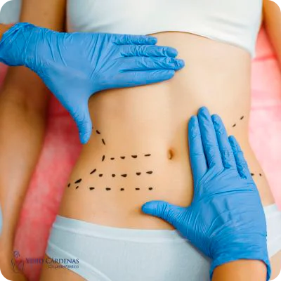Abdominoplastia medellin colombia