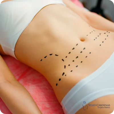 medellin abdominoplastia colombia