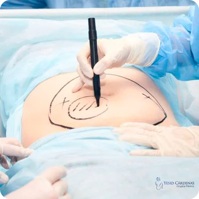 liposuccion laser medellin