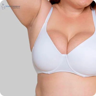 Mamoplastia de reducción