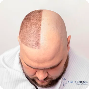 Cuidados del injerto de cabello con el Dr. Yesid Cárdenas