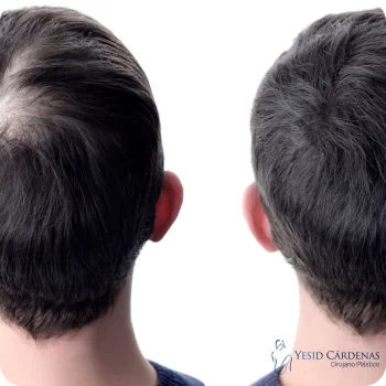 Dr.Yesid Injerto de Cabello