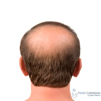 Injerto de cabello medellín Dr. Yesid Cárdenas