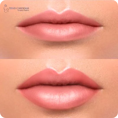 lipoinyeccion de labios medellin
